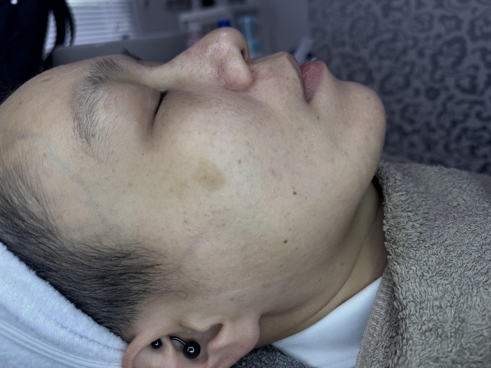 佩穎 療程後
